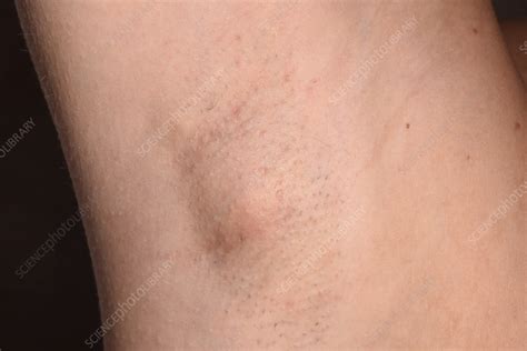 Swollen Lymph Node Stock Image C Science Photo Library