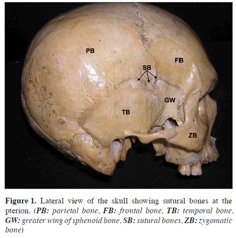 Unusual Sutural Bones At Pterion