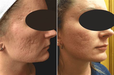Nonsurgical Approach To Deep Acne Scars With Rf Microneedling And