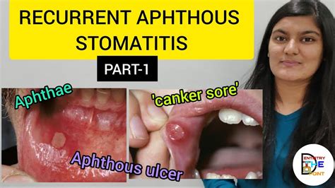 Recurrent Aphthous Stomatitis Ras Part Youtube