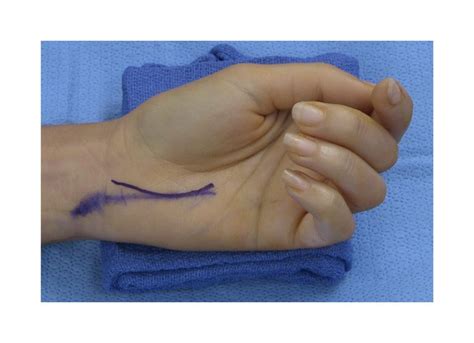 Carpal Tunnel Release Surgical Education Learn Surgery Washington