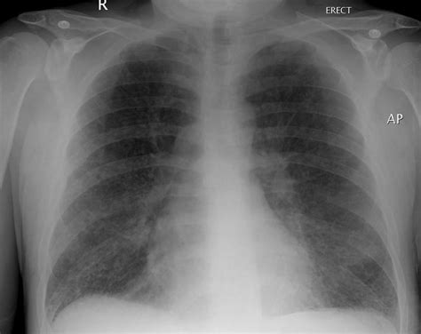 Cystic Lung Disease Radrounds Radiology Network