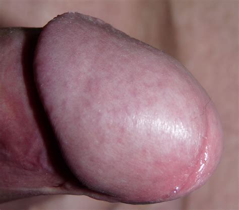 File Penis Glans Wikimedia Commons