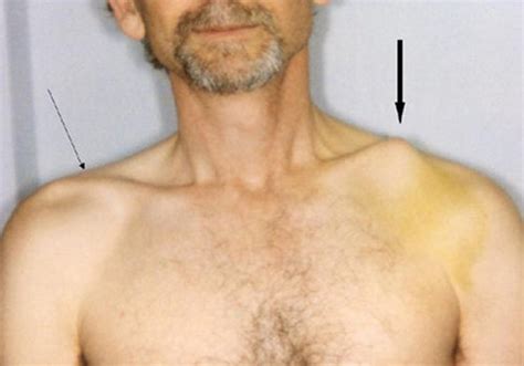 Collarbone Pain Clavicle Pain Causes And Treatment