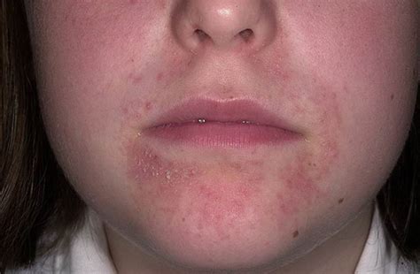 Dermatitis On Face Photos Symptoms And Pictures