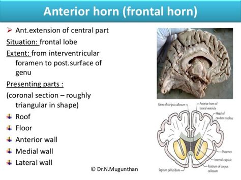 Lateral Ventricle Of Brain By Drnmugunthanms