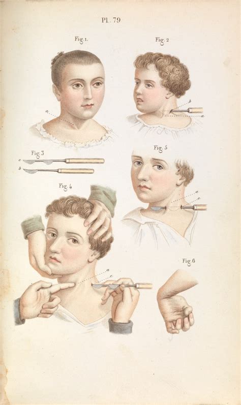 plate 79 surgical techniques for torticollis and club hand wellcome collection