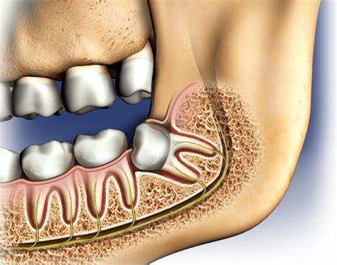 What Is The Procedure Called To Remove Wisdom Teeth Teethwalls