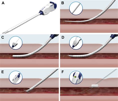 Percutaneous Vascular Closure Device In Minimally Invasive Mitral Valve