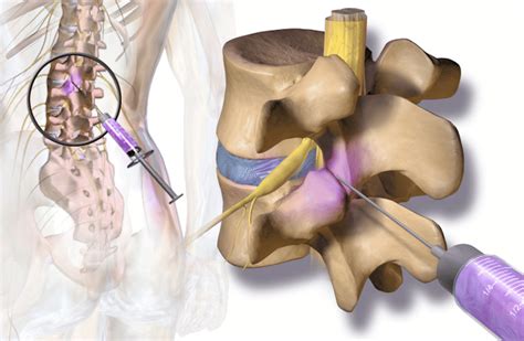 Rfa Radiofrequency Ablation Surgery For Back Pain