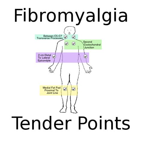 Fibro Tender Points Diagram Wiring Diagram Pictures