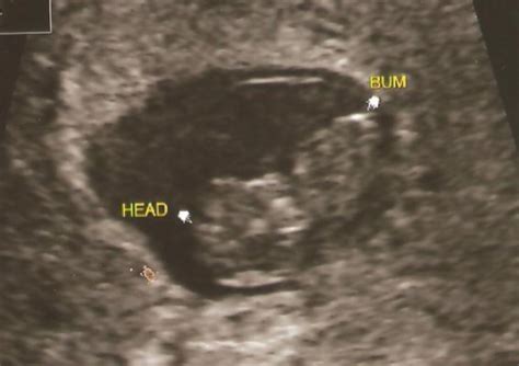 Dating Ultrasound With Pic March 2016 Babycenter Canada