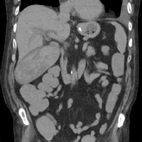 Ct Scan Of Abdomen Demonstrating A Distended Gallbladder Of Mixed
