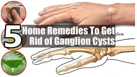 Ganglion Cysts Symptoms Causes And Risk Factors Images And Photos Finder