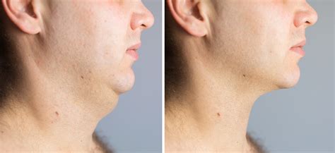 Man Before And After Double Chin Fat Correction Procedure Stock Photo