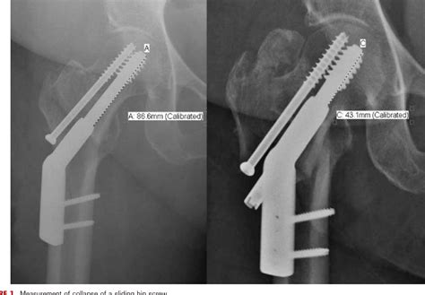 Cephalomedullary Nail Versus Sliding Hip Screw For Fixation Of Ao 31 A1