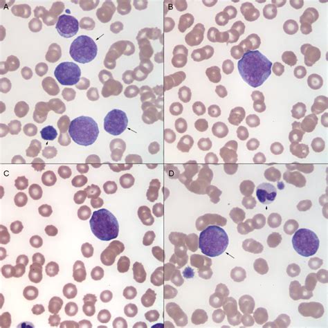 Blast Versus Promonocyte Versus Monocyte Eclinpath