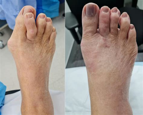 Bunion And Hammertoe Foot And Podiatry Surgery