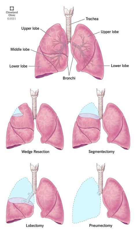 Lung Resection Surgery Procedure Details And Recovery An Tâm