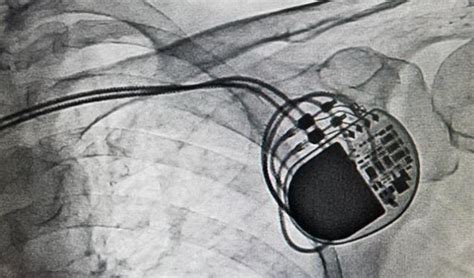 Pacemakers and icds generally last 5 to 7 years or longer, depending on usage and the type of device. One in Four ICD Patients Need Reintervention Within 5 ...