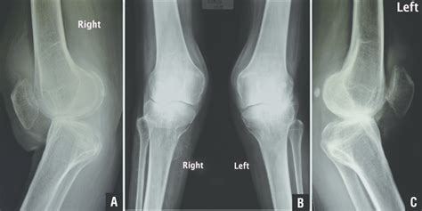 Preoperative Lateral Radiograph Of The Right Knee A Anteroposterior