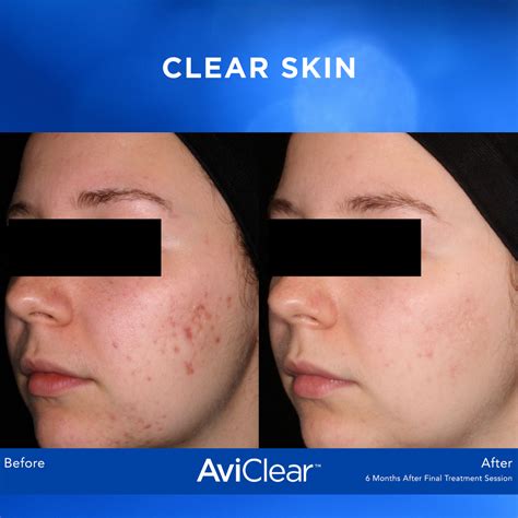 Aviclear Laser Acne Treatment By A Greater Houston Tx Dermatologist