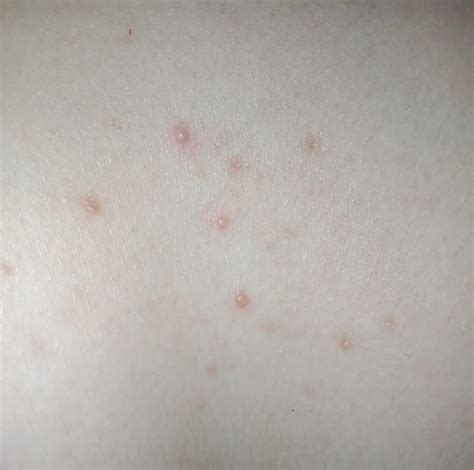 Is This Folliculitis Ive Had This Kind Of Bumps All Over My Jaw