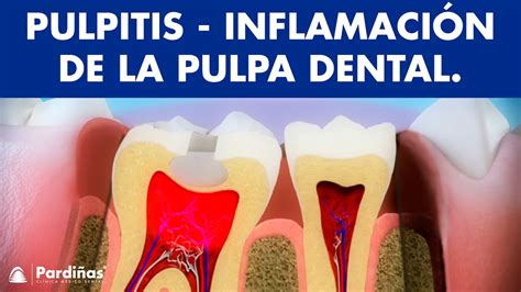 Pulpitis Inflamación De La Pulpa Dental © Youtube