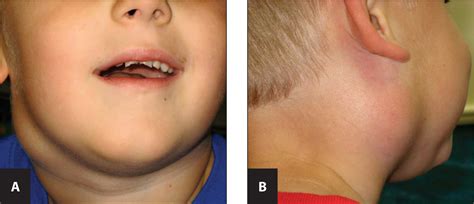 Managing Cervical Lymphadenitis—a Total Pain In The Neck Pediatric