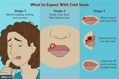 How To Cover A Cold Sore Scab With Makeup Mugeek Vidalondon