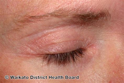 Psoriasis On The Eyelid Symptoms And 5 Treatment Tips Mypsoriasisteam