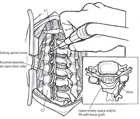 Shunt Externalization Neupsy Key