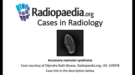 Accessory Navicular Syndrome Radiopaedia Org Cases In Radiology Youtube