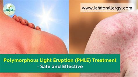 Polymorphous Light Eruption Pmle Treatment Safe And Effective