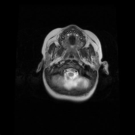 Joubert Syndrome Radiology Case