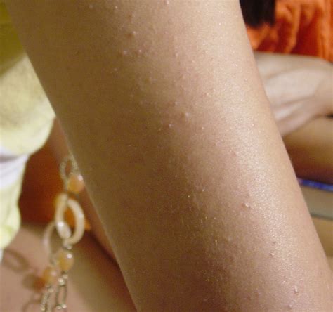 Keratosis Pilaris K P Is A Skin Condition Effecting Roughly Half Of The Population And