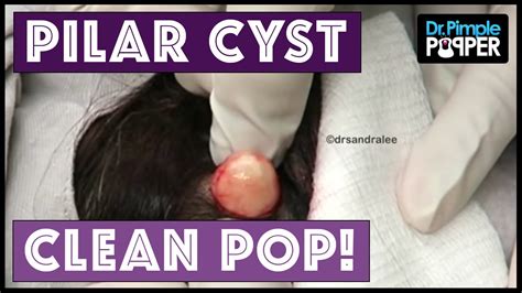 A Clean Pilar Cyst Pop Youtube