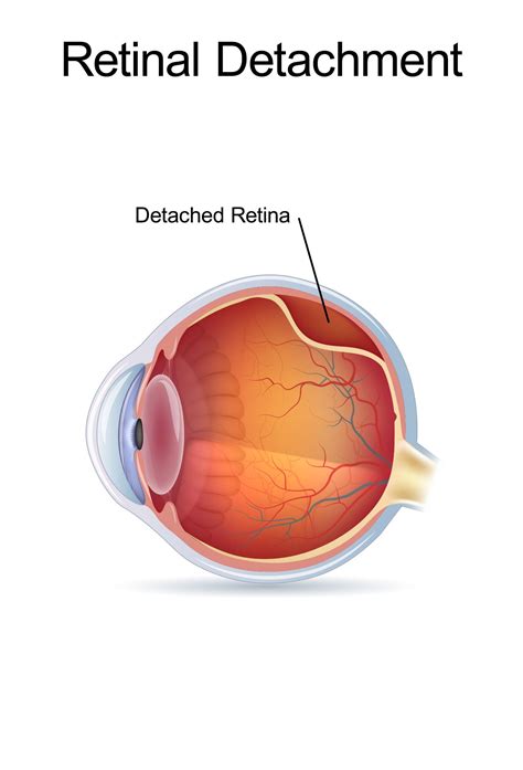 Nashville Tn Retinal Detachment Signs And Symptoms Causes And Treatments