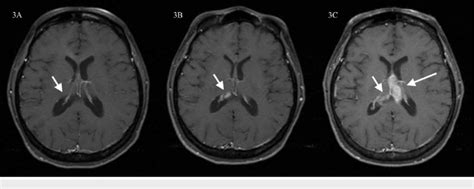 Post Contrast Axial T1 Weighted Image Mri Of The Brain At Two Figure