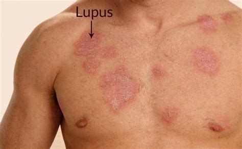 Çfarë është Sëmundja E Lupus It Lupus Symptoms Lupus Skin Body Rash