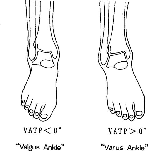 Valgus Vs Varus Of Ankle