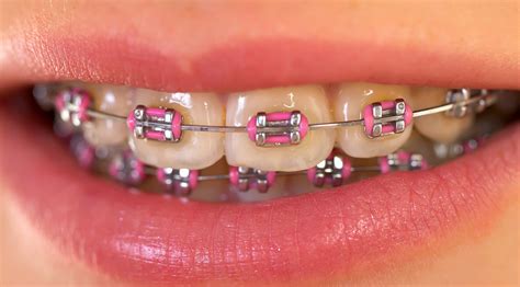 Untuk pengetahuan anda, terdapat pelbagai pilihan jenis pendakap gigi seperti metal braces, ceramic braces dan clear braces. Nad's Braces Journey - Before Decide Pakai Braces - Hukum ...