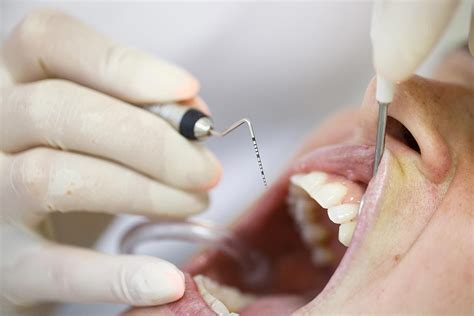 Causes Of Receding Gums General Dentist Houston Texas