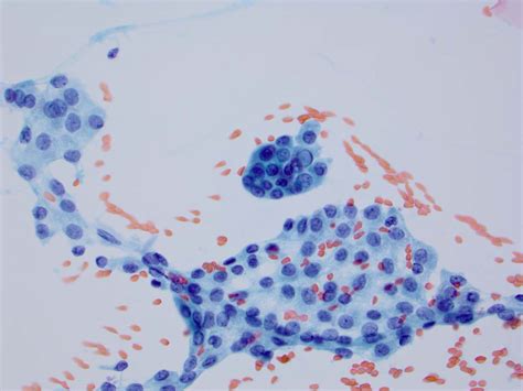 Cytopathology The Atypical Thyroid Fna Dr Edmund Cibas Edcibas