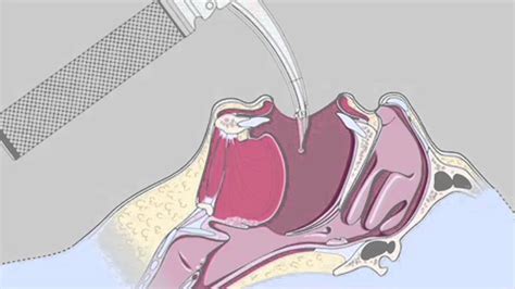 Larynx Anatomy Laryngoscopy