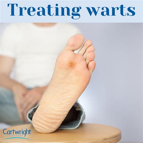 Why Do Warts Pop Up On The Bottom Of Cartwright Podiatry
