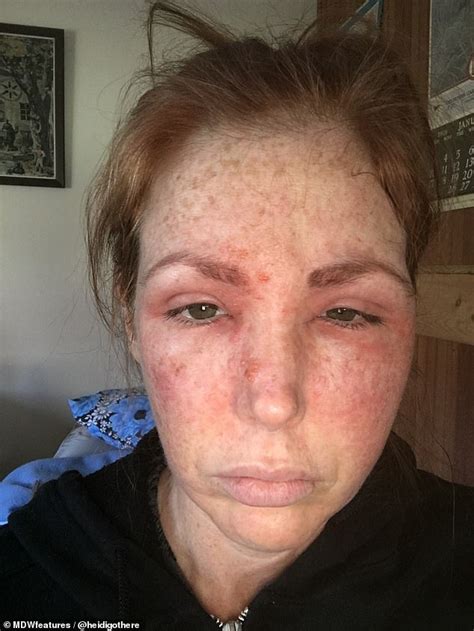Woman 42 Wakes Up With A Black Eye And Swollen Face After Being
