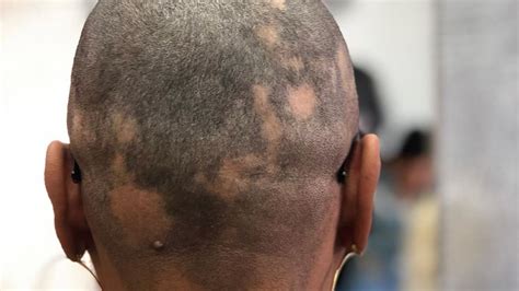 Everything You Need To Know About Alopecia Areata The Healthcare Daily
