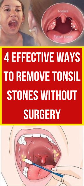 Herbal Medicine 4 Effective Ways To Remove Tonsil Stones Without Surgery