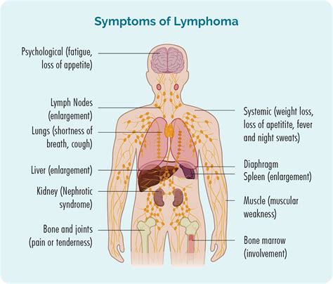 Grey Zone Lymphoma Gzl Lymphoma Australia